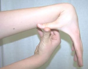 Hypermobile Ehlers-Danlos syndrome is an inherited connective tissue disorder that is caused by defects in a protein called collagen. It is generally considered the least severe form of (EDS) although significant complications can occur